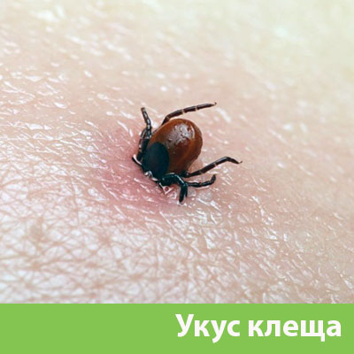 Укус клеща в Вельске