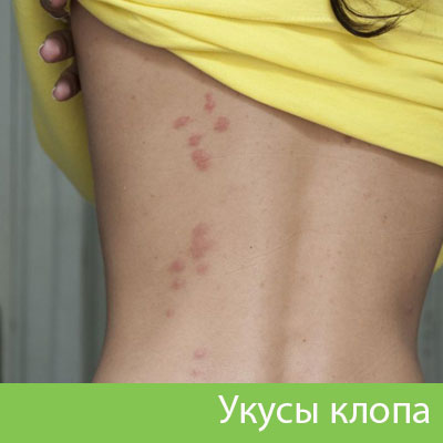 Профессиональное уничтожение клопов в Вельске